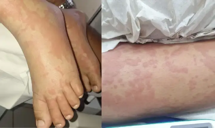 Criança é internada por suspeita de contaminação após uso de detergente